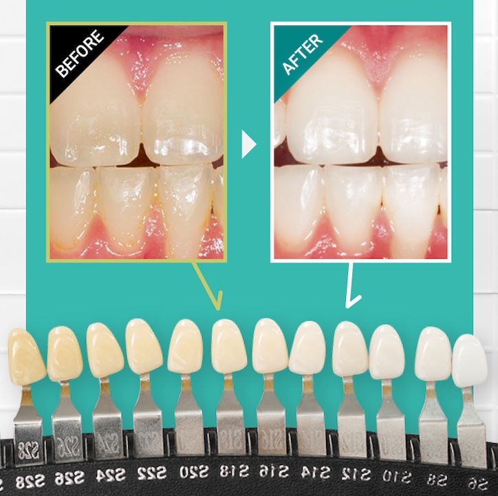 ディノベート公式サイトのホワイトジェルパックを使ったビフォーアフター画像